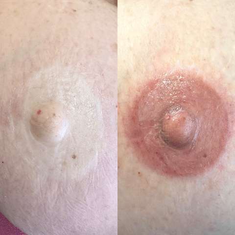 Areola restoration result