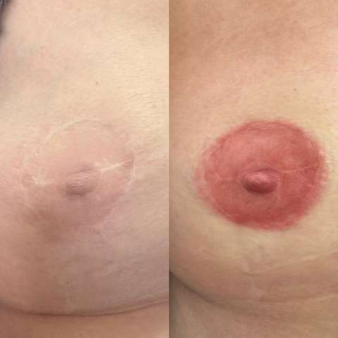 Areola restoration result