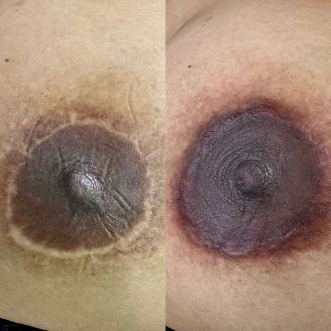 Areola restoration result