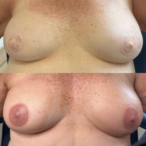 Areola restoration result