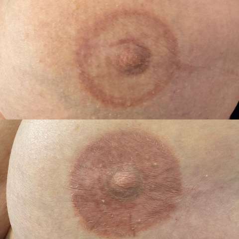 Areola restoration result