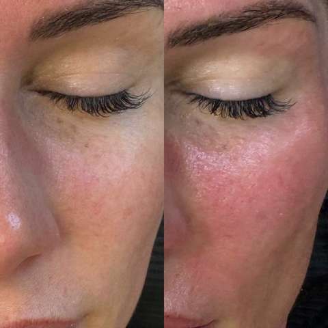 Beauty treatment result