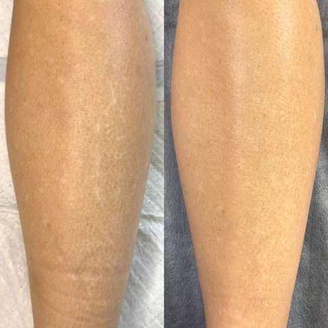 Skin camouflage result