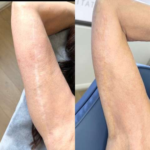 Skin camouflage result