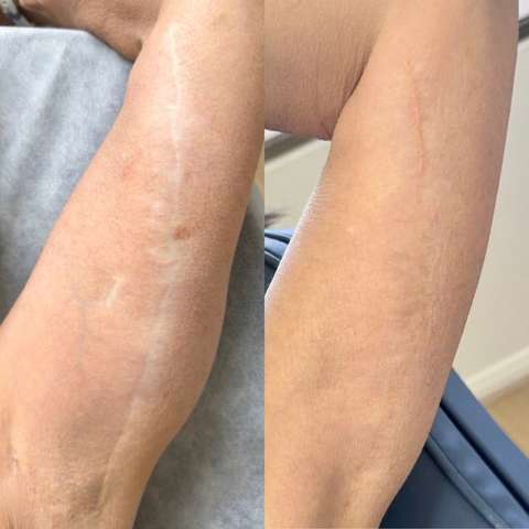 Skin camouflage result
