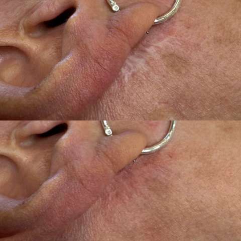 Skin camouflage result
