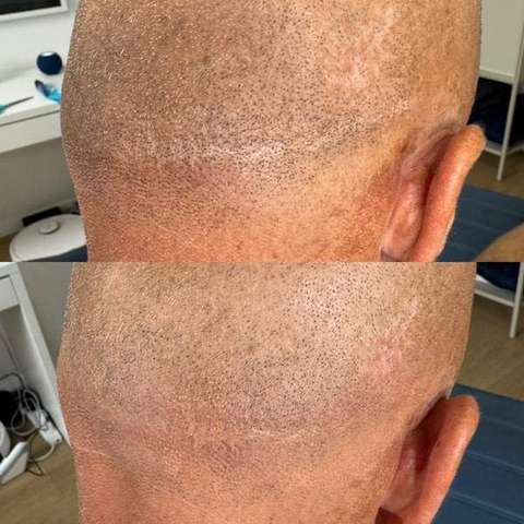 Skin camouflage result