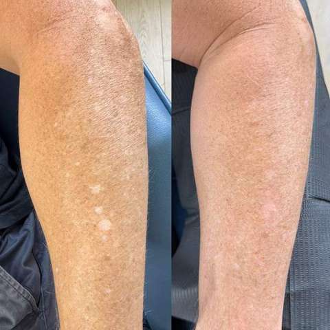 Skin camouflage result