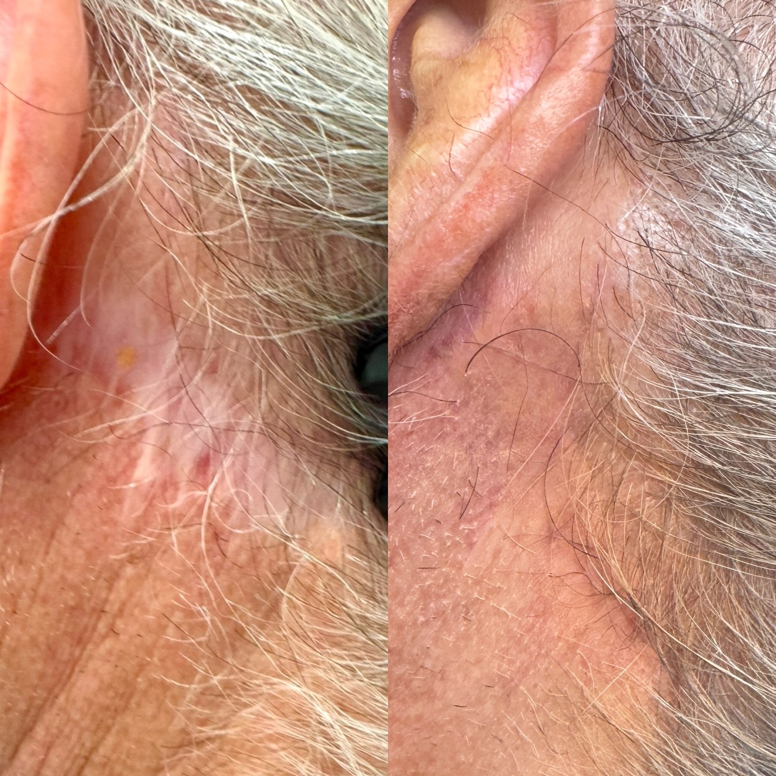 Surgical Scar Camouflage before and after, 3 sessions