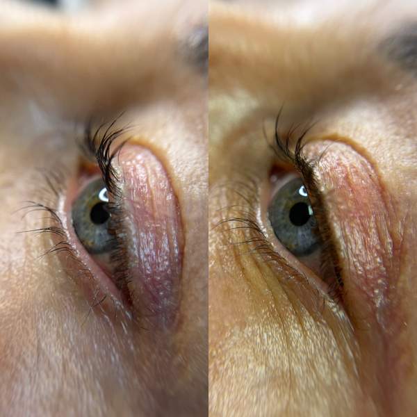 Lash line enhancement result