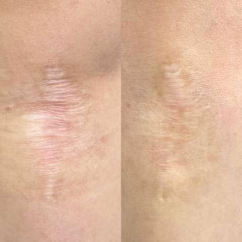 Scar revision result