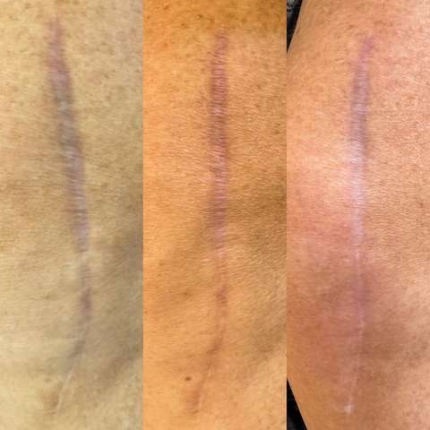 Scar revision result