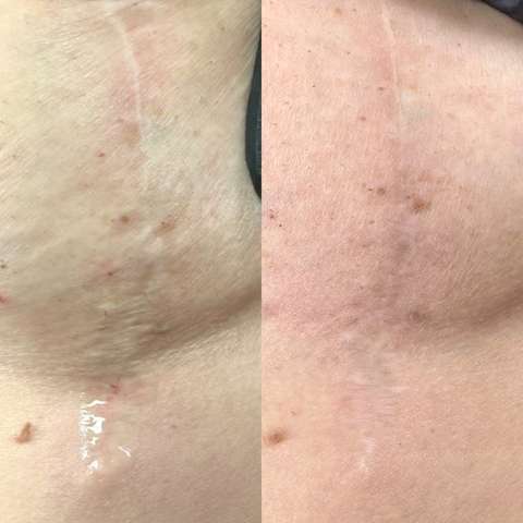 Scar revision result