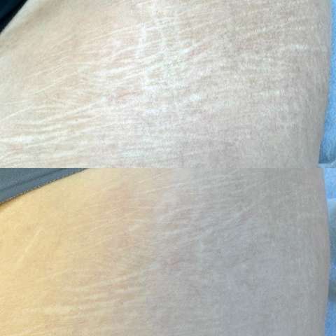 Scar revision result