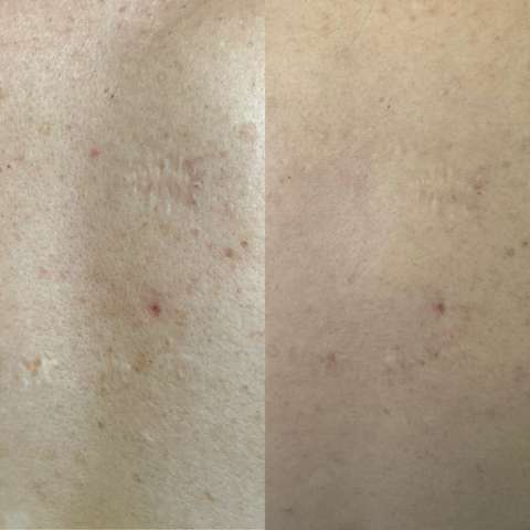 Scar revision result