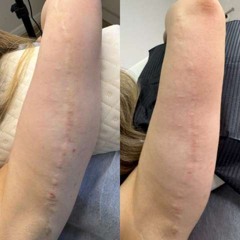 Scar revision result