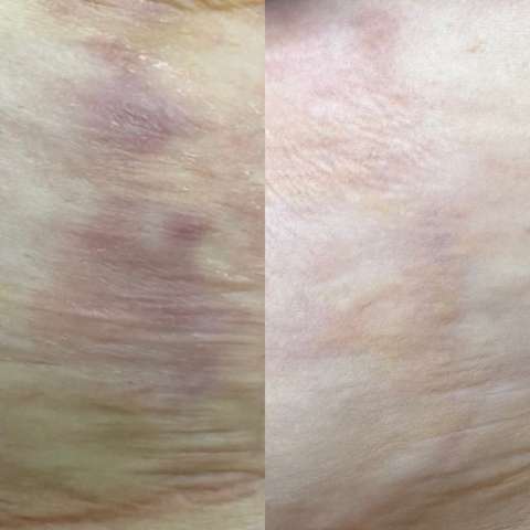 Scar revision result
