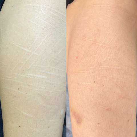 Scar revision result