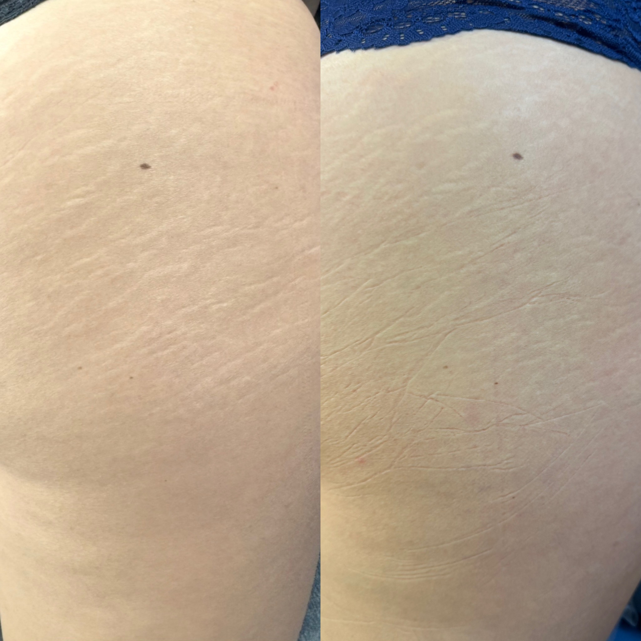 Stretch mark revision before and after result 1