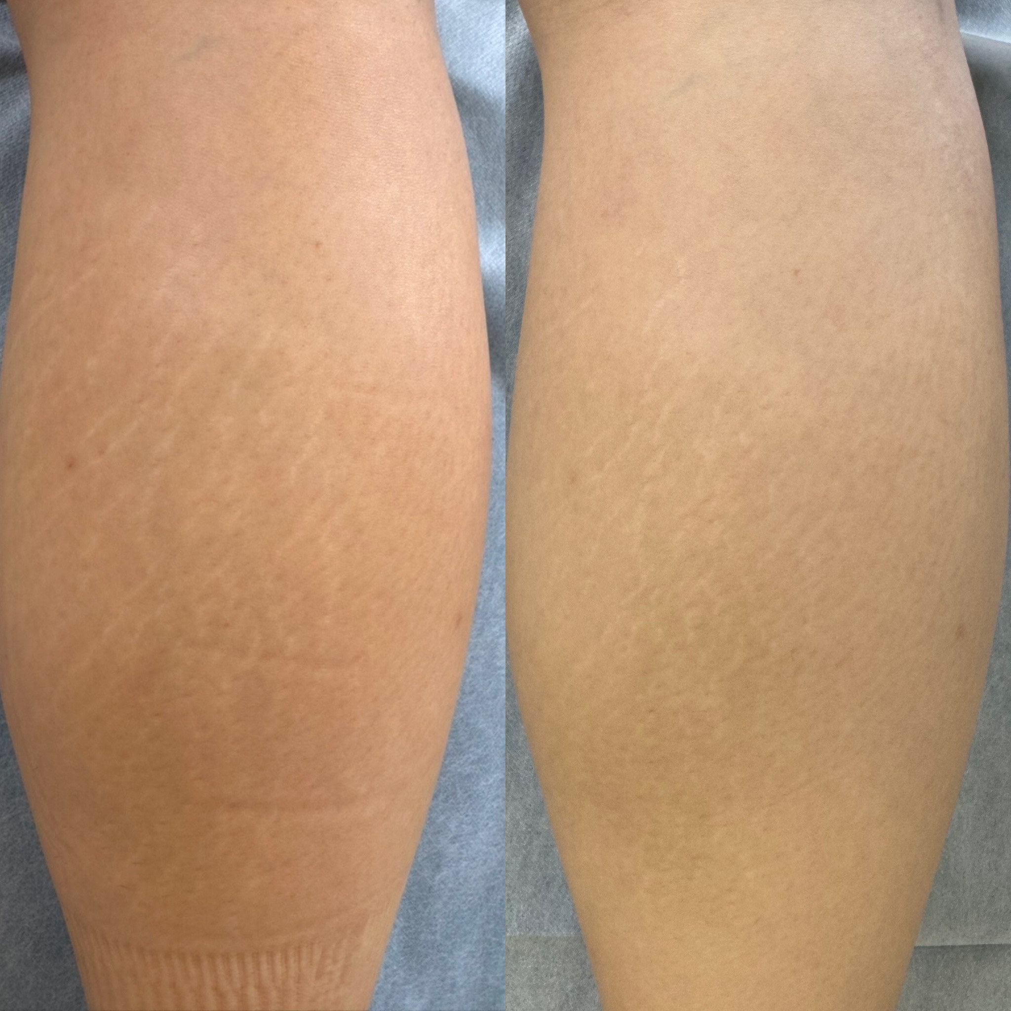 Stretch mark revision before and after result 2