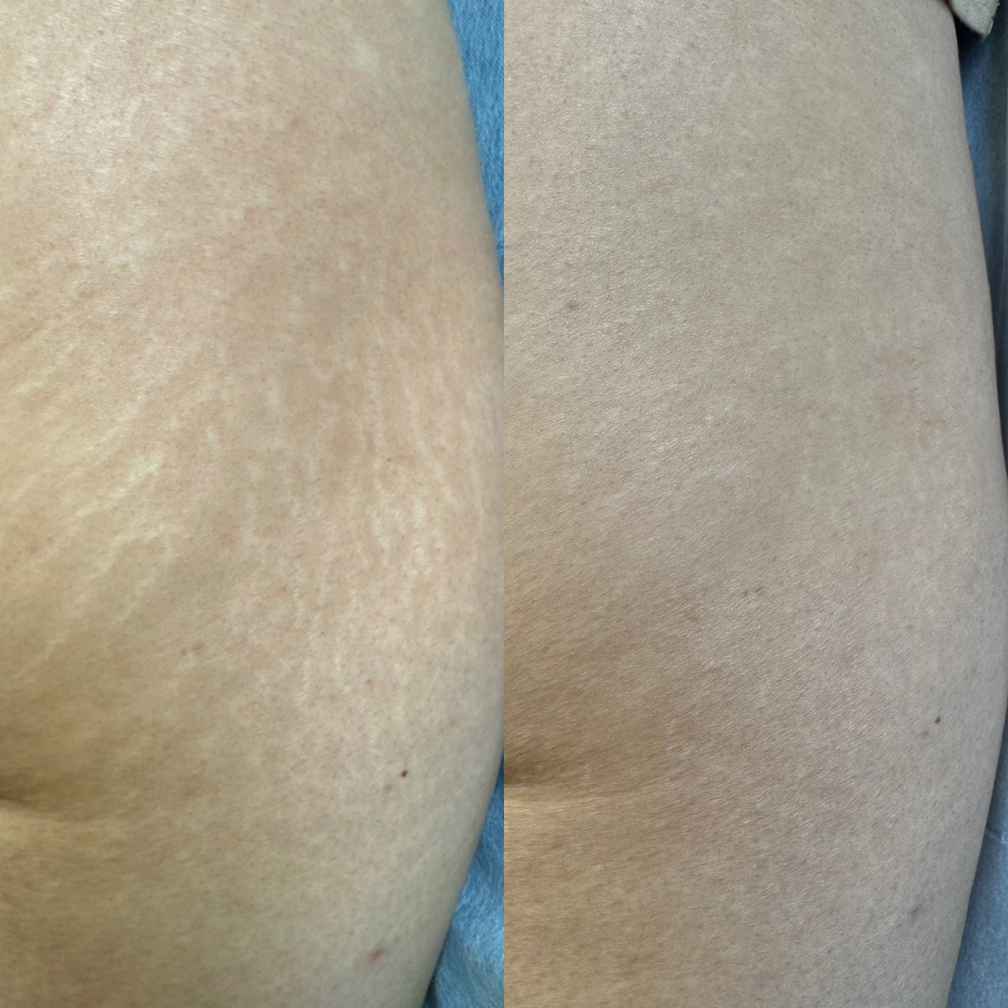 Stretch mark revision before and after result 3