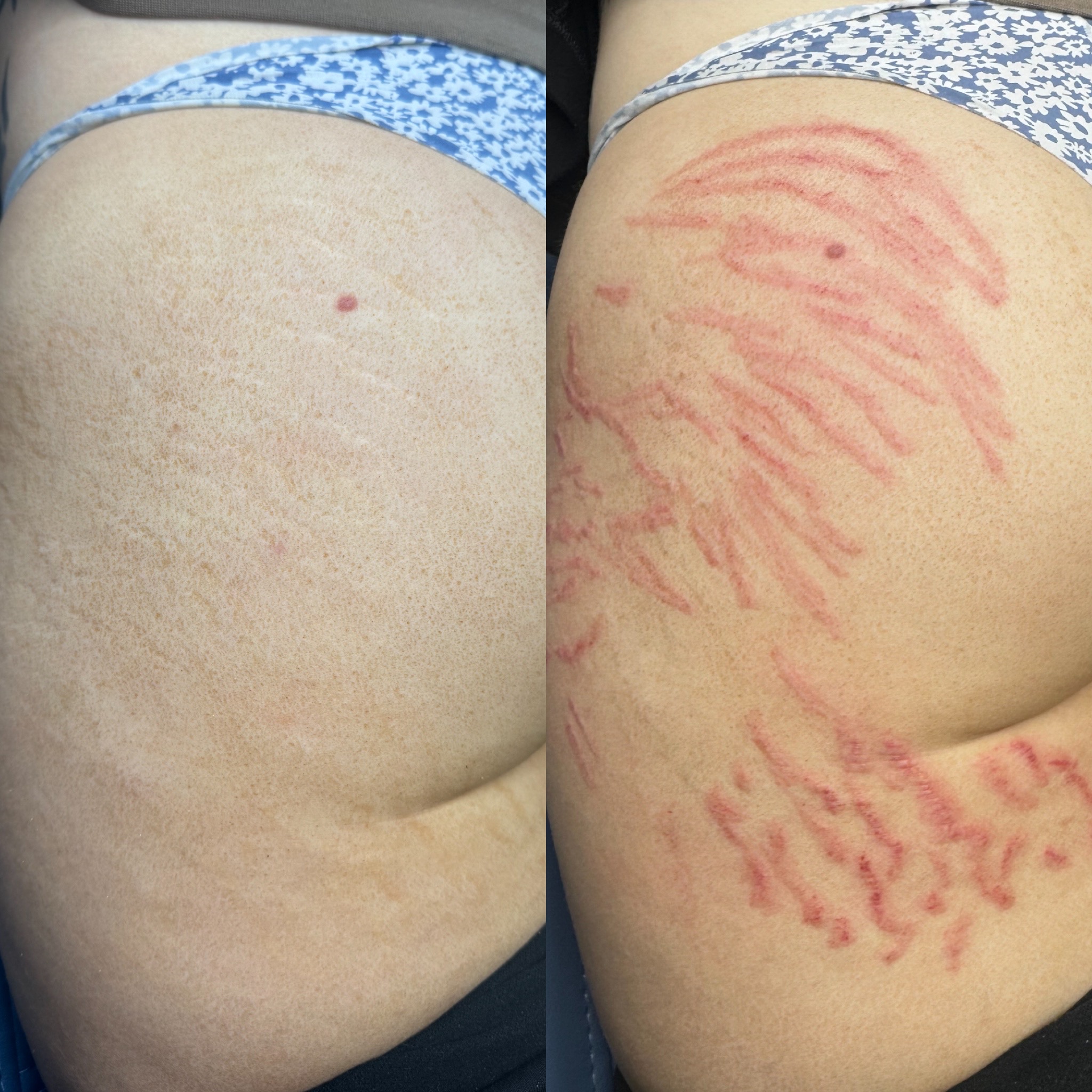Stretch mark revision before and after result 4