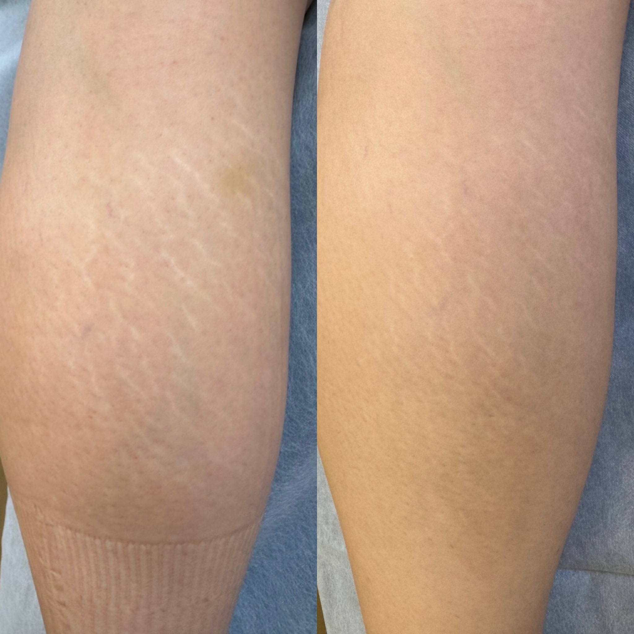 Stretch mark revision before and after result 5