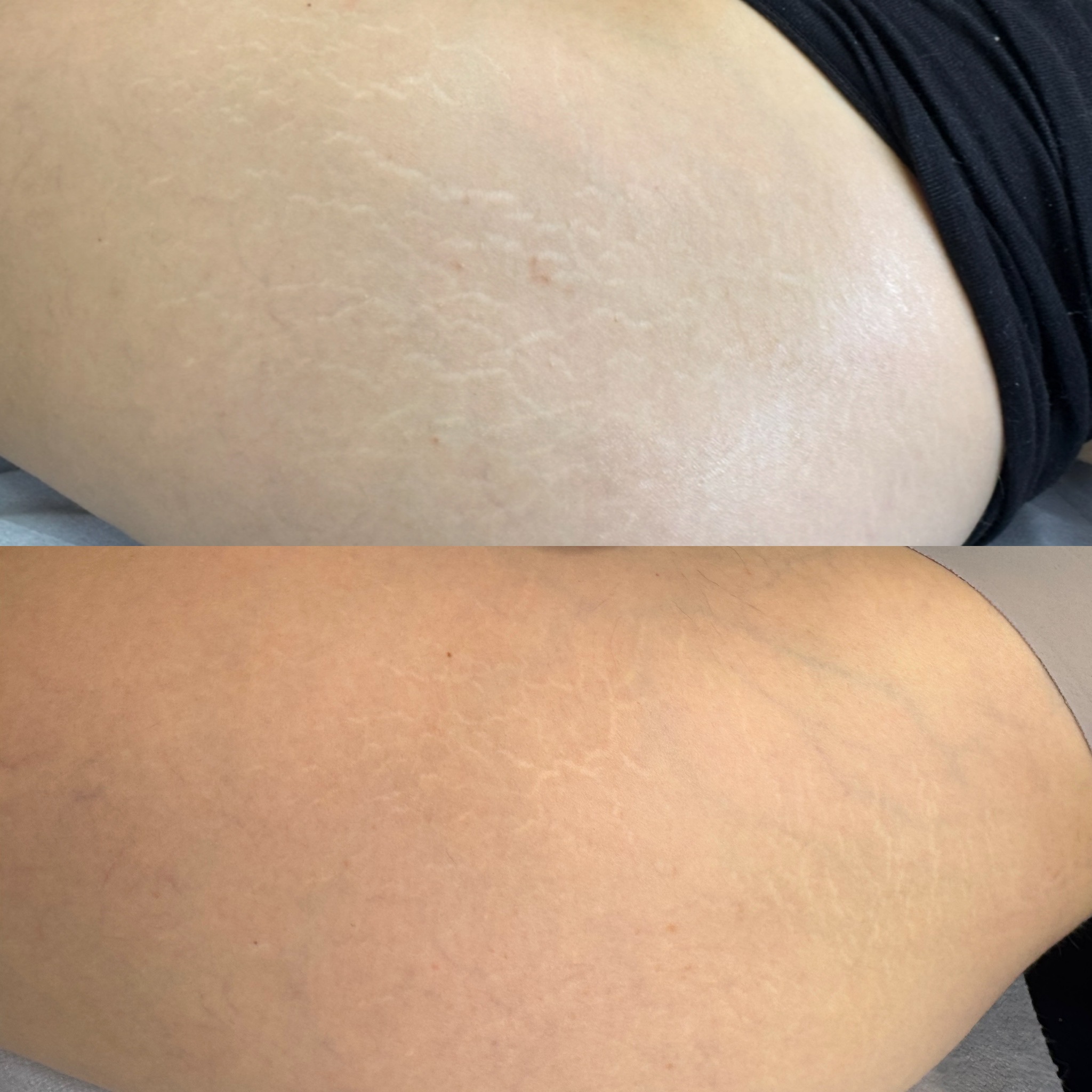 Stretch mark revision before and after result 6