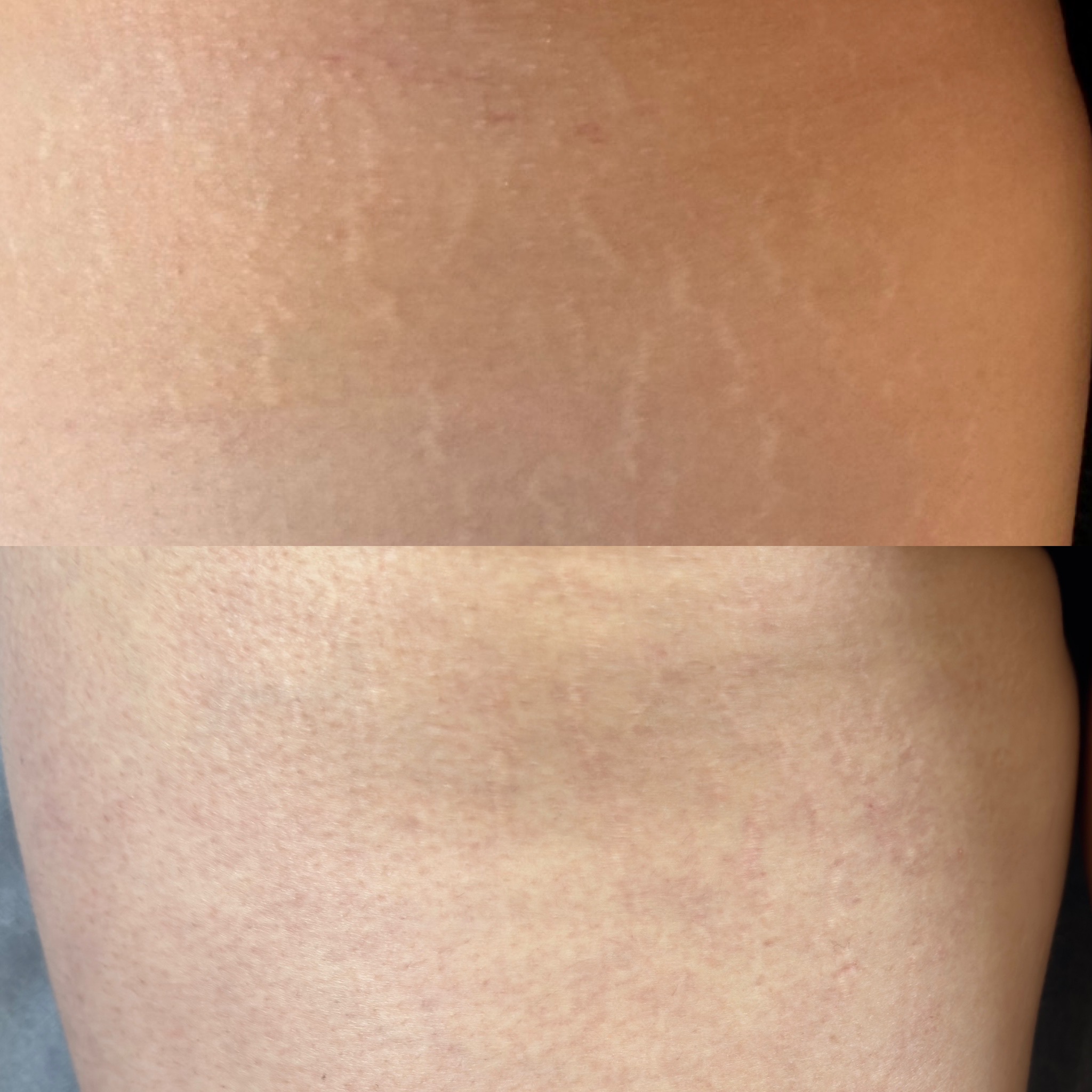 Stretch mark revision before and after result 7