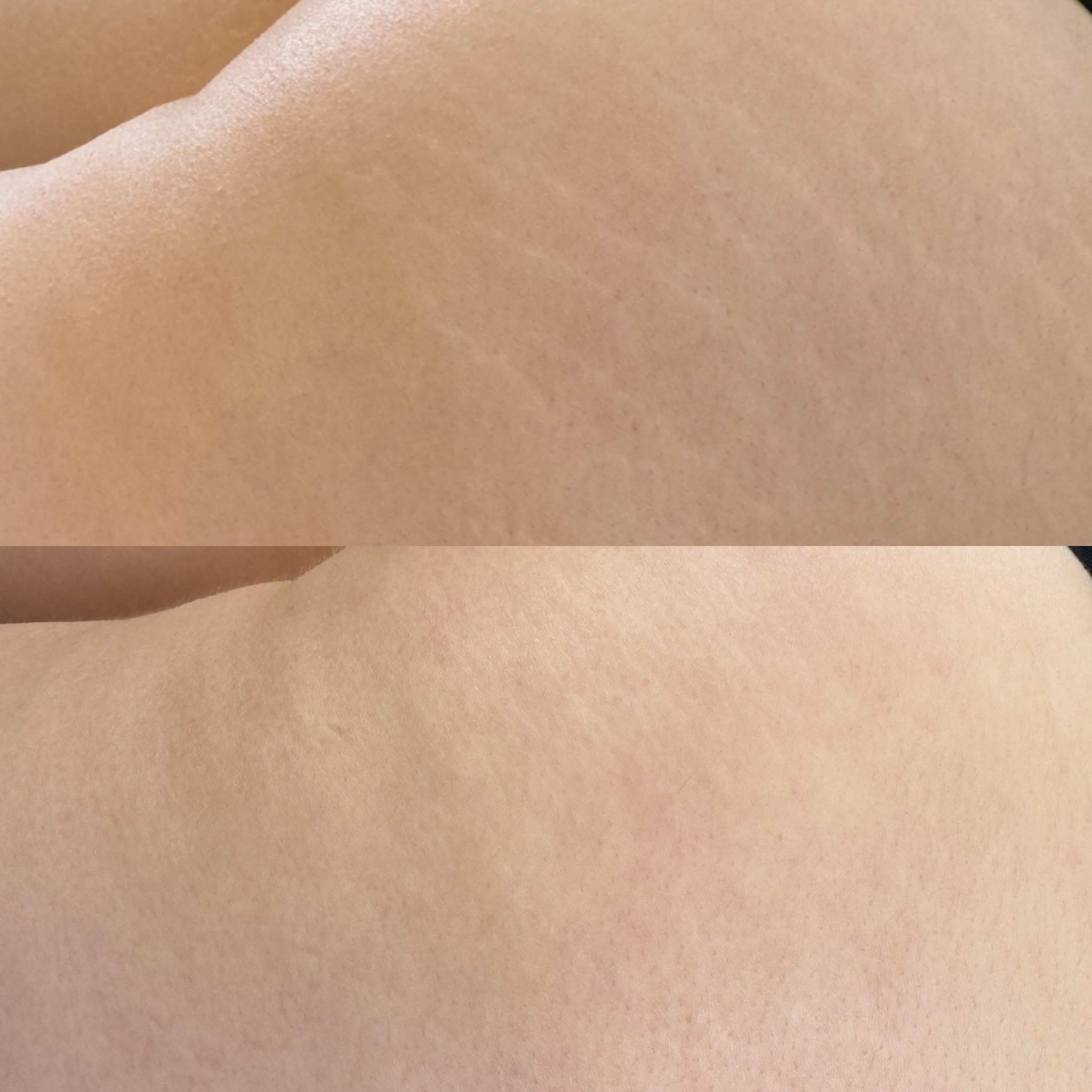 Stretch mark revision before and after result 8